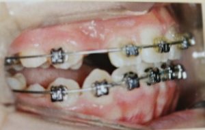 치아 교정-이미지
